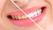 Breaching teatment, woman perfect whiten teeth