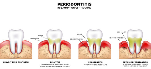 Sticker - Periodontitis, inflammation of the gums, detailed illustration