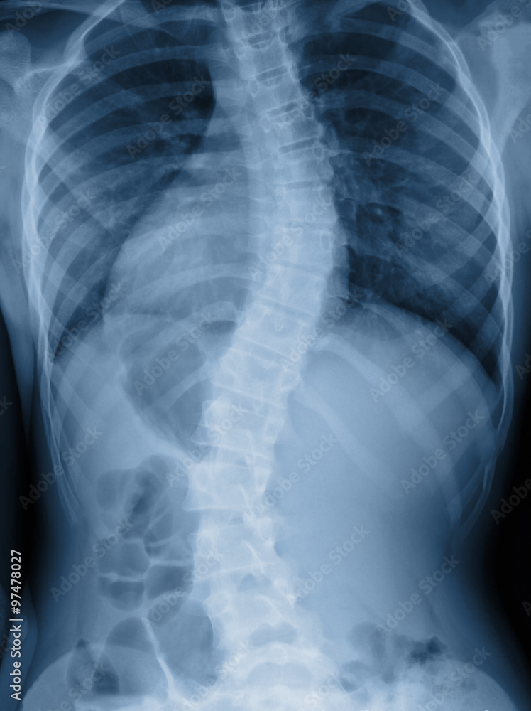 Scoliosis film x-ray show spinal bend in teenager patient - obrazy, fototapety, plakaty 