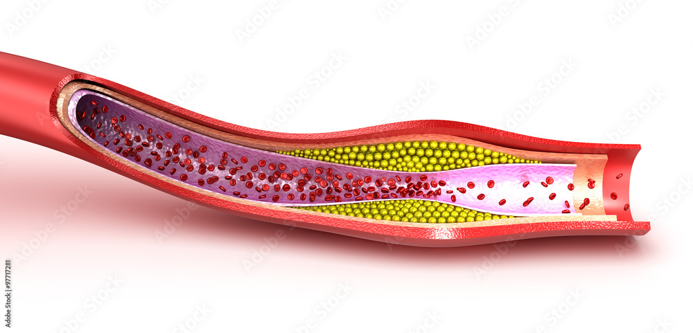 Cholesterol plaque in blood vessel, illustration Stock Illustration ...