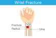 Diagram of wrist have bone fracture