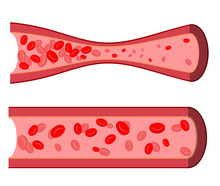  Bloody Artery. Blockage Of Blood Vessels. Sick Artery With Leuk