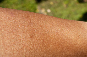 human skin