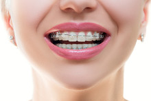 Close Up Braces On Teeth. Braces Smile. Orthodontic Treatment. Closeup Smiling Face With Braces. Front View. .