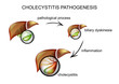 cholecystitis pathogenesis. pathogenesis 