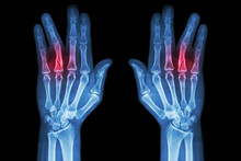 Fracture Shaft Of Proximal Phalange Of Ring Finger ( Film X-ray Both Hand AP )