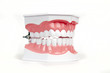a model of the teeth - dentures