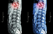 Spine metastasis ( cancer spread to thoracic spine ) ( MRI of thoracic and lumbar spine : show thoracic spine metastasis and compress spinal cord ( Myelopathy ) ) ( sagittal plane )