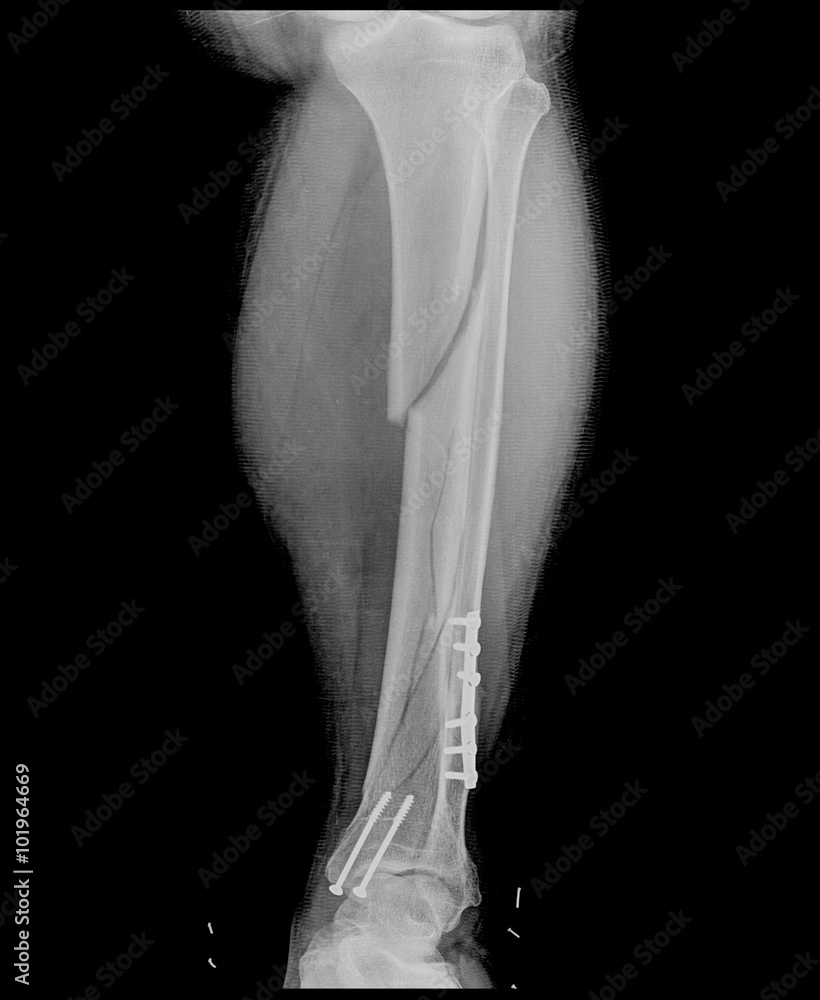 X-ray of the broken leg / Many others X-ray images in my portfolio. Stock  Photo | Adobe Stock, image size:820x1000