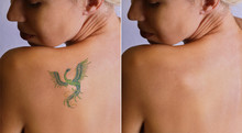 Laser Tattoo Removal Before And After. Beautiful Young Woman With Tattoo On Her Back