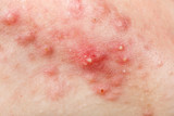 Fototapeta  - Nodular cystic acne skin