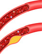 Illustration of cholesterol blocking artery