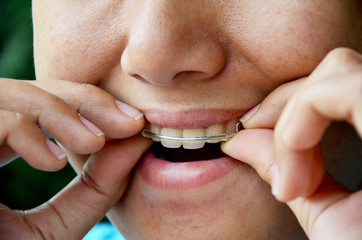 Thai woman putting Retainer fashion