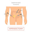© marina_ua - Laparoscopic appendectomy - appendix removal