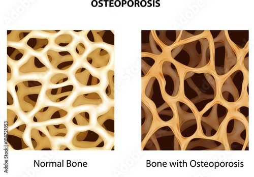 Fotografía Illustration of normal bone and bone with osteoporosis