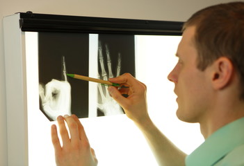 specialist watching image of hands and fingers  at xray film viewer