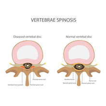 Back Pain. Spin Stenosis. Vertebrae Disease Vector Format