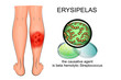 erysipelas of the lower leg