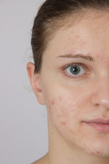 Beautiful young girl with acne on his face and the back on a whi