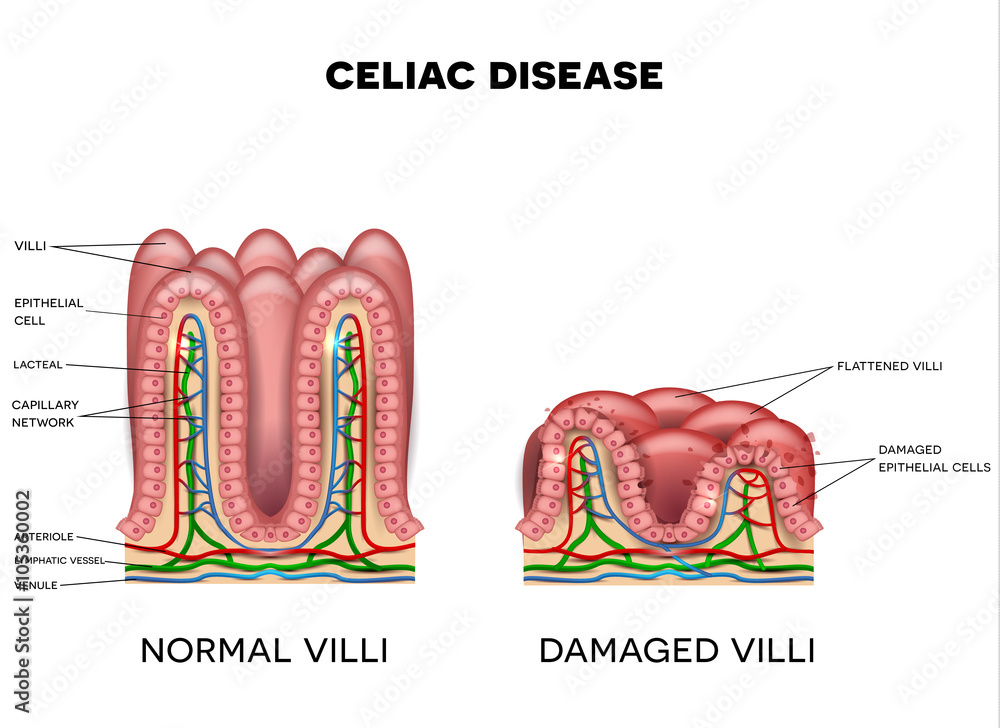 Celiac disease affected small intestine villi on a white background ...