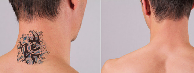 Laser tattoo removal before and after. Attractive Man with tattoo on his neck