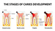 © designua - stages of caries development