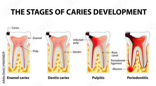 Fotografía stages of caries development
