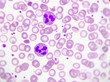 Neutrophil cell (white blood cell) in peripheral blood smear
