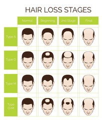 Information chart of hair loss stages and types of baldness illustrated on a male head.