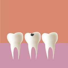 Filling tooth in mouth, Vector illustration.