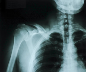 Naklejka na meble X-rays used in the treatment