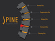 Spine anatomy disc degeneration, medical conceptual infographic vector