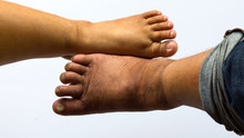 Above The Feet Of Obese People.