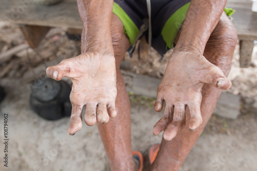Cuadros en Lienzo Hansen's disease,closeup hands of old man suffering from leprosy