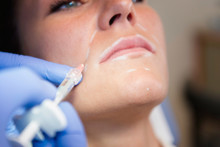 Collagen Injection Treatment