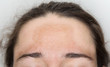 canvas print picture - Junge Frau mit Pigmentflecken auf der Stirn