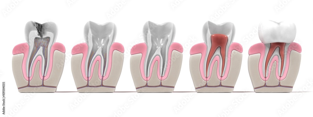 3d renderings of endodontics - root canal procedure