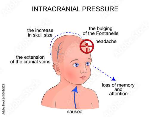 The Symptoms Of Intracranial Pressure In Children Buy This Stock Vector And Explore Similar Vectors At Adobe Stock Adobe Stock