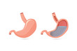 Illustration of outside of stomach muscular and inside which can saw gastric acid.