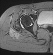 © Connect Images - MRI of 20 year old female hip with signs of Hemangioma on upper right thigh