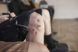© HEX - Close up of man's bruised knee