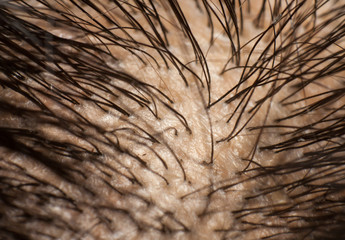 Dandruff on scalp and dark hair. Macro shot