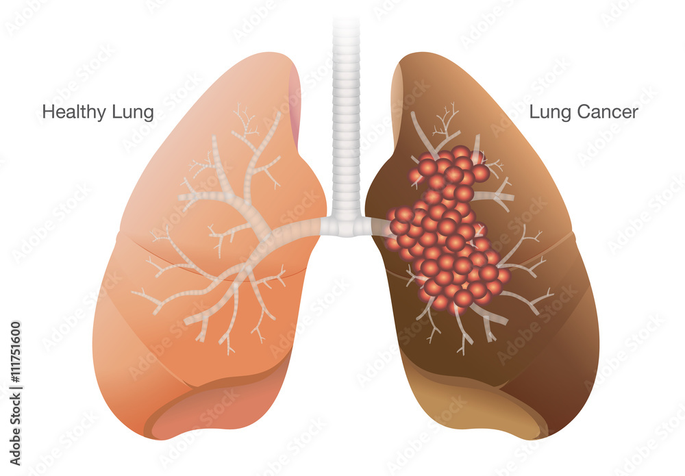 Comparison between healthy lung and cancer lung isolated on white ...