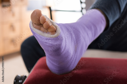 Fotografía Purple blue Fiberglass / Plaster leg cast
