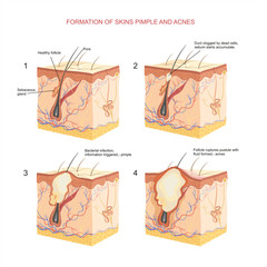 pimple and acnes