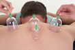 Multiple vacuum cup of medical cupping therapy on body