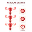 © Anastasiia Lavrentev - cervical cancer schematic illustration