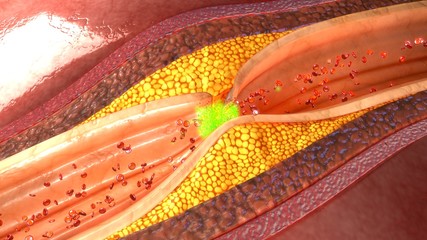 Wall Mural - Thrombolytic therapy