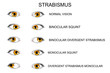 eyes. types of strabismus