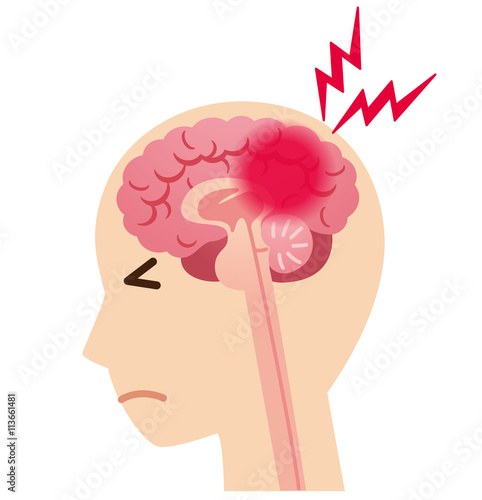 頭痛 脳梗塞 脳の病気 Stock イラスト Adobe Stock